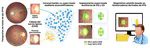 Towards a better understanding of glaucoma through fundus photography