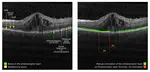 Automated Quantification of Photoreceptor alteration in macular disease using Optical Coherence Tomography and Deep Learning