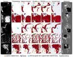 A deep learning model for brain vessel segmentation\ in 3DRA with arteriovenous malformations