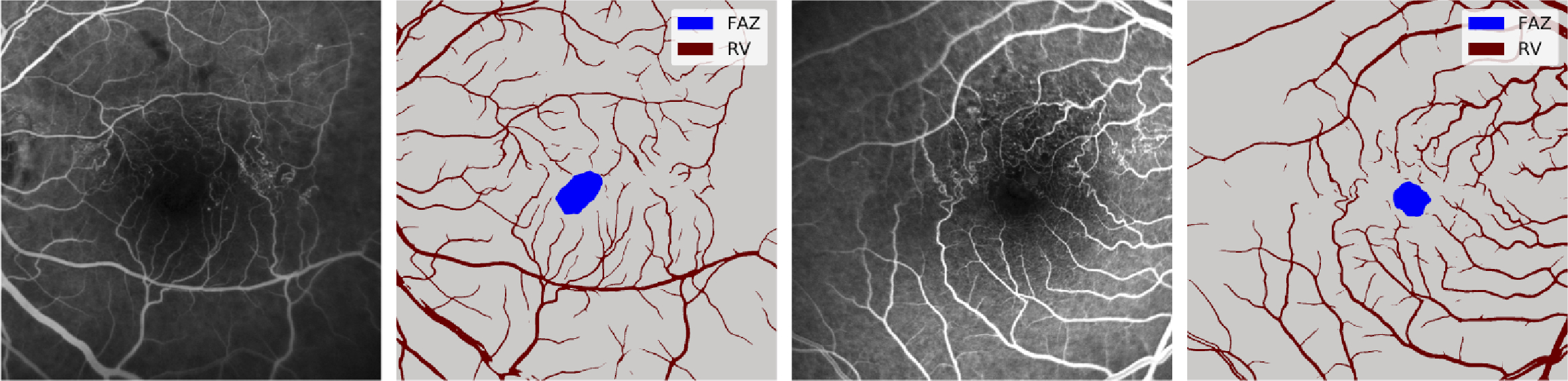 Improving foveal avascular zone segmentation in fluorescein angiograms ...