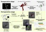Computer Aided Intracranial Aneurysm Treatment Based on 2D/3D Mapping, Virtual Deployment and Online Distal Marker Detection