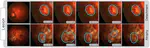 Semi-supervised learning with Noisy Students improves domain generalization in optic disc and cup segmentation in uncropped fundus images