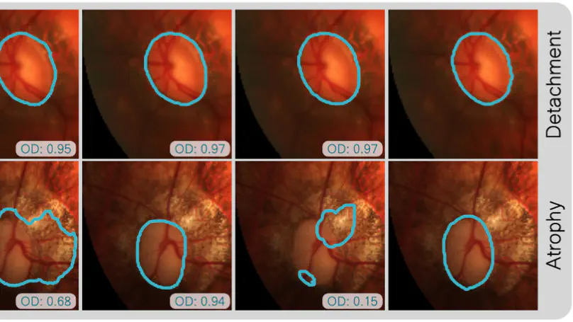 Semi-supervised learning with Noisy Students improves domain generalization in optic disc and cup segmentation in uncropped fundus images
