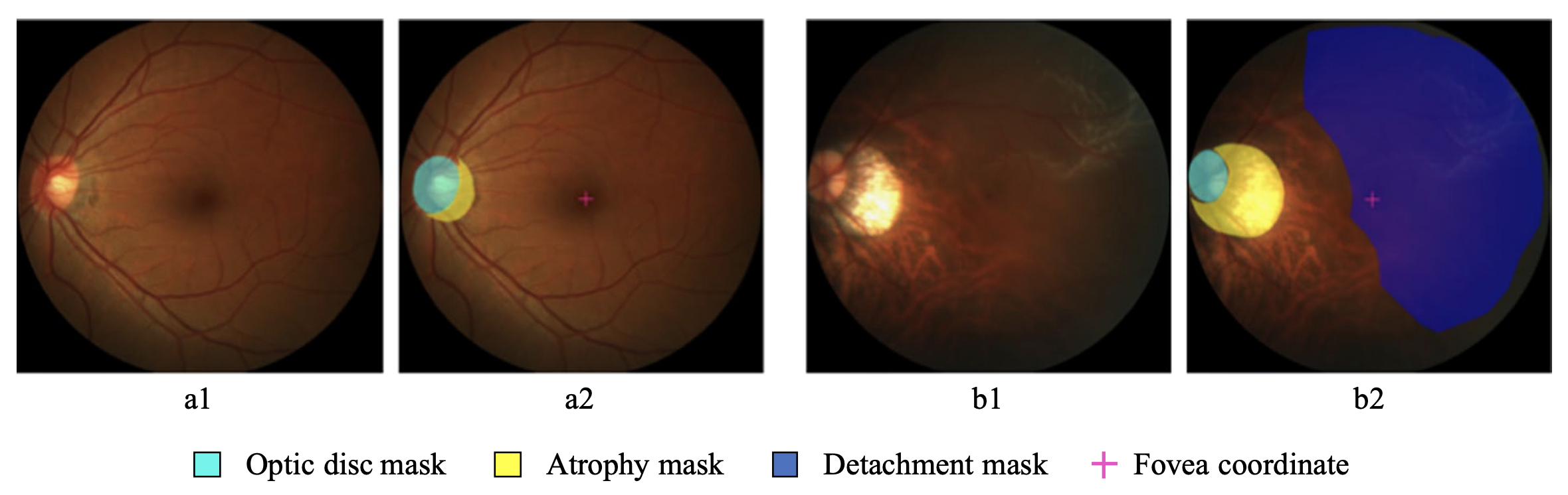 Open Fundus Photograph Dataset with Pathologic Myopia Recognition and ...