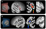 A Self-supervised Deep Learning Model for Diagonal Sulcus Detection with Limited Labeled Data